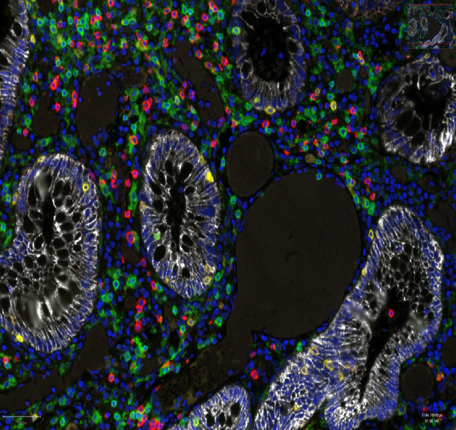 Microscope image of tissue showing several circular and oval structures with bright white, web‑like patterns. Surrounding them are many small coloured cells marked in green, blue, red and yellow against a dark background.