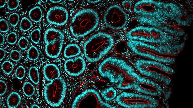 A scientific image of bowel cancer cells, with fluorescent red and blue colours.